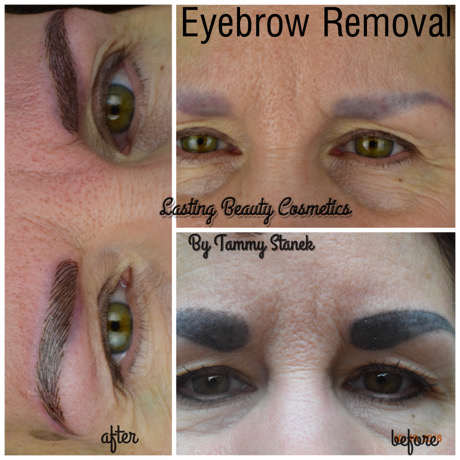 eyebrow tattoo removal Madison